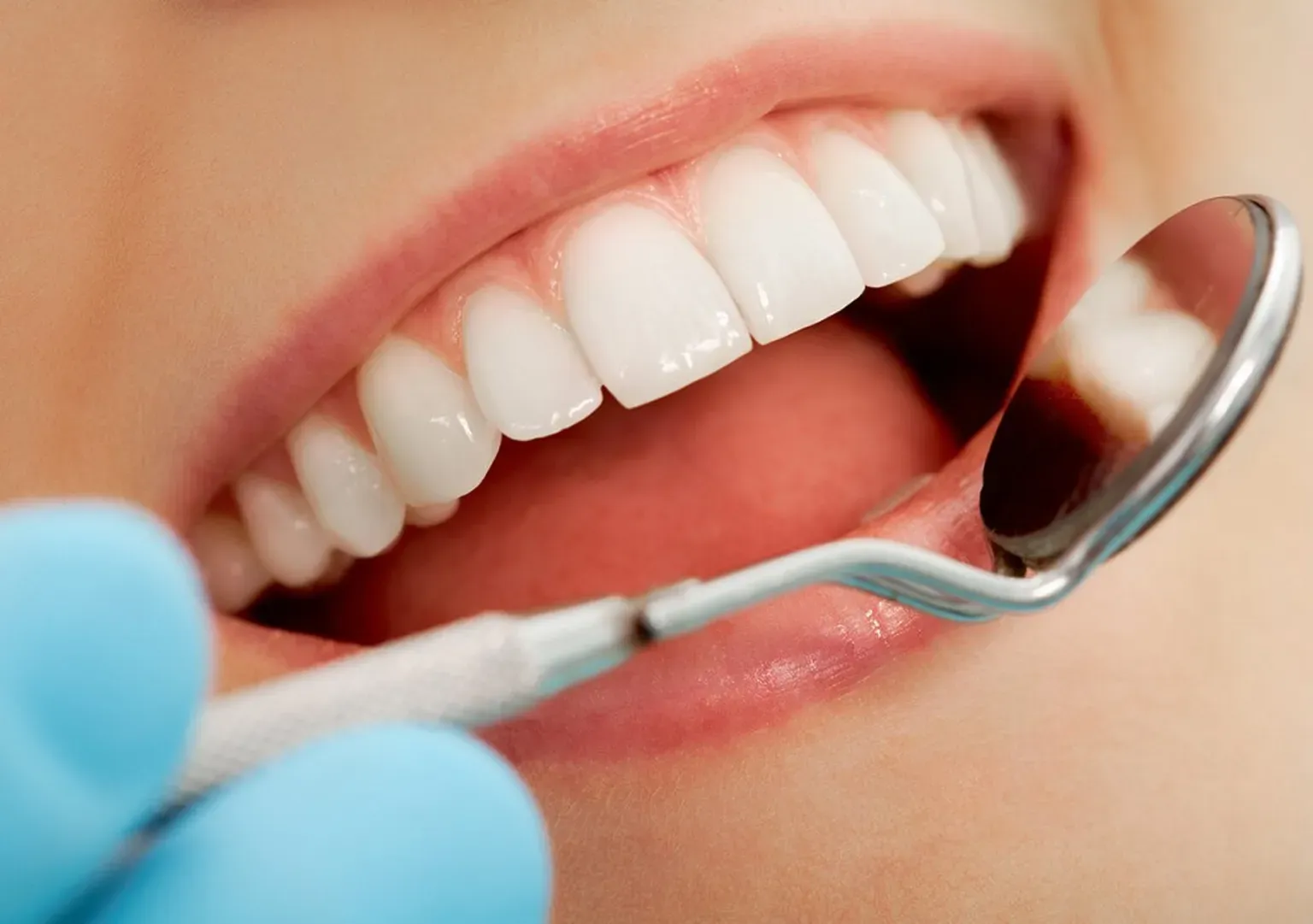 FAQs About Porcelain Veneers For Teeth Restorations In Newport Beach, CA