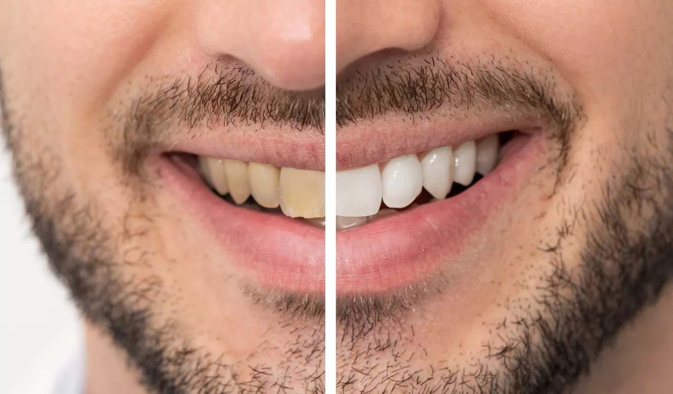 Dr. Russell Kelly and Newport Dental Art will help you with a Smile Makeover in Newport Beach