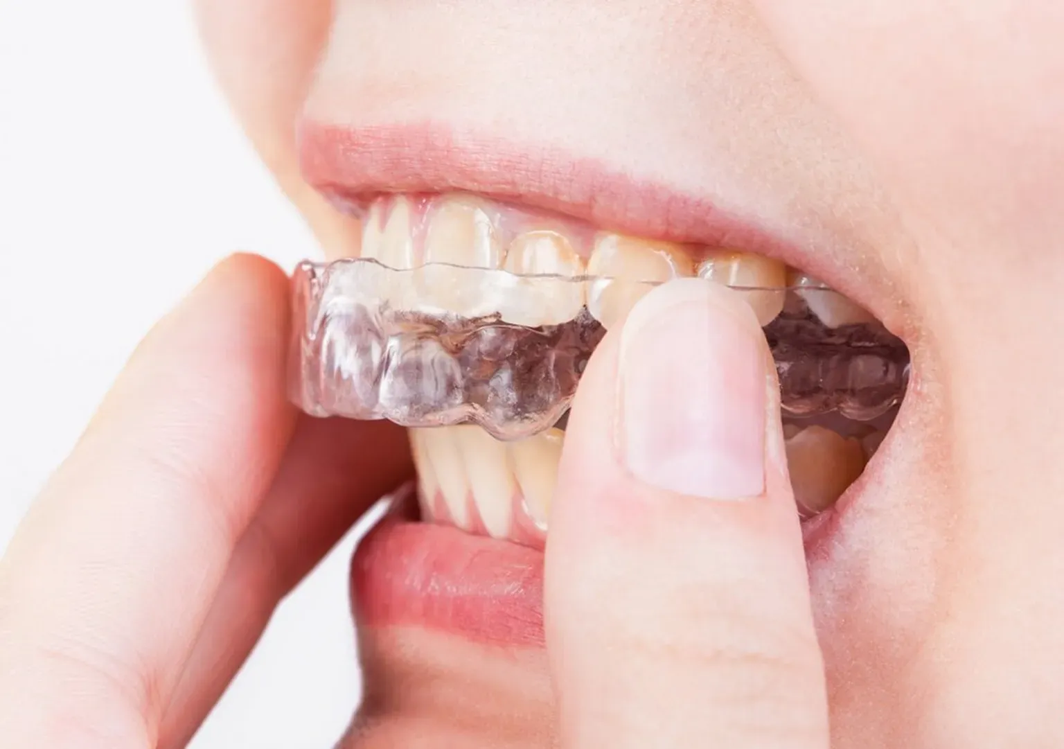 Newport Dental Arts Offers Invisalign Clear Braces