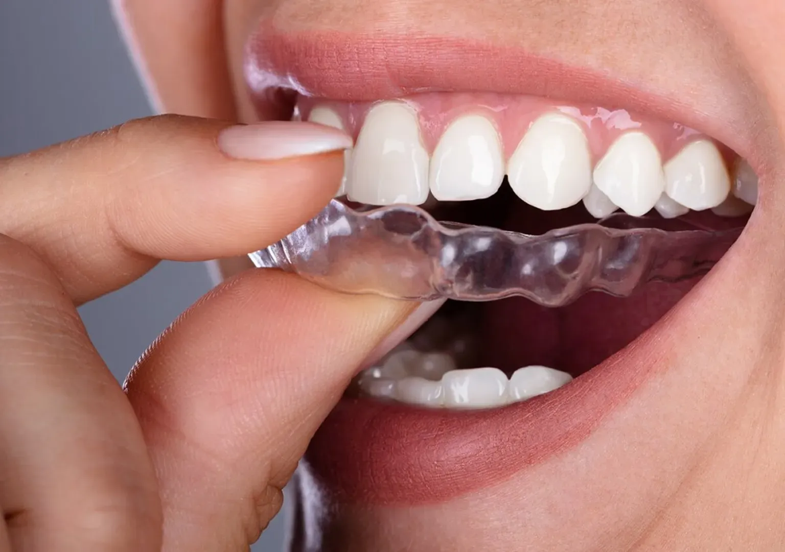Achieving a Brighter Smile with Invisalign in Newport Beach
