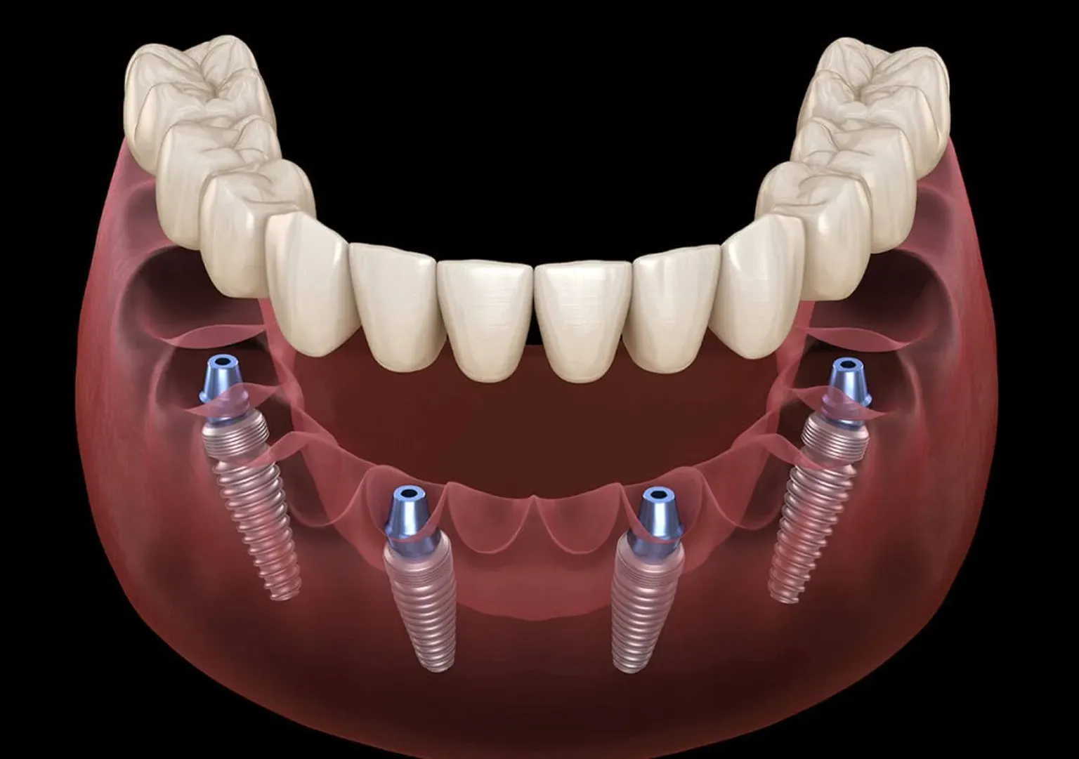 The Benefits Of Implant-supported Dentures When Replacing Missing Teeth