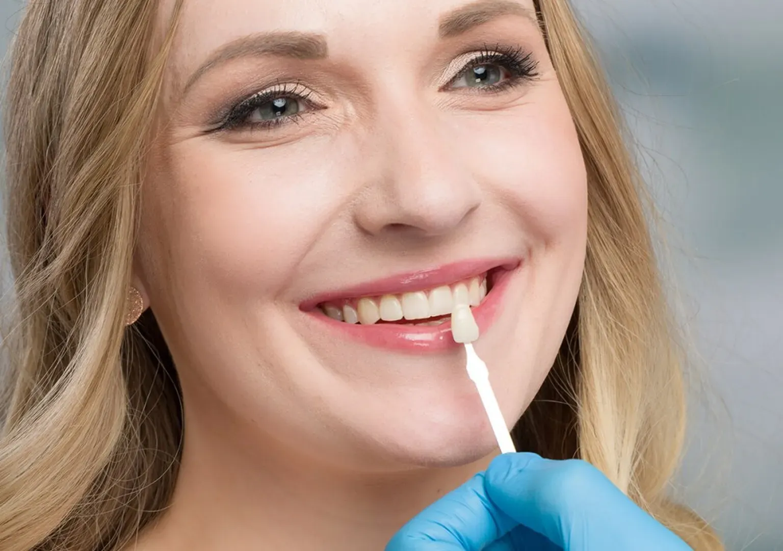 Benefits of Dental Veneers: A Brief Guide