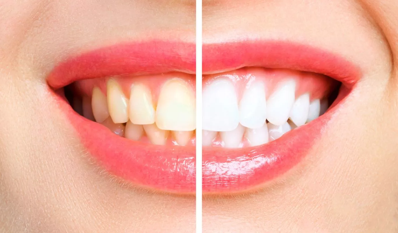 5 Bright Tips for Teeth Whitening Success