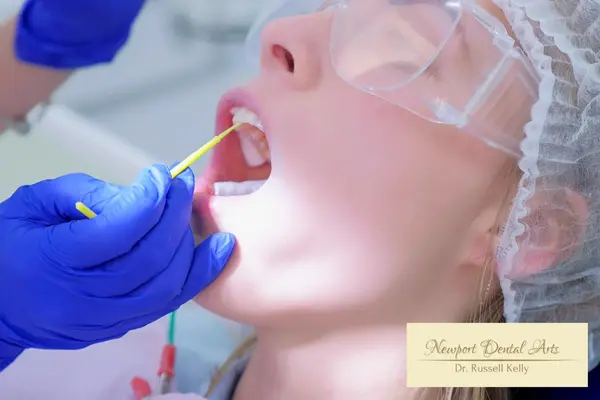 Fluoride treatment at Newport Dental Arts to strengthen enamel for patients on GLP-1 medications
