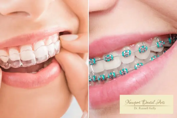 Invisalign treatment vs Braces newport beach dentist
