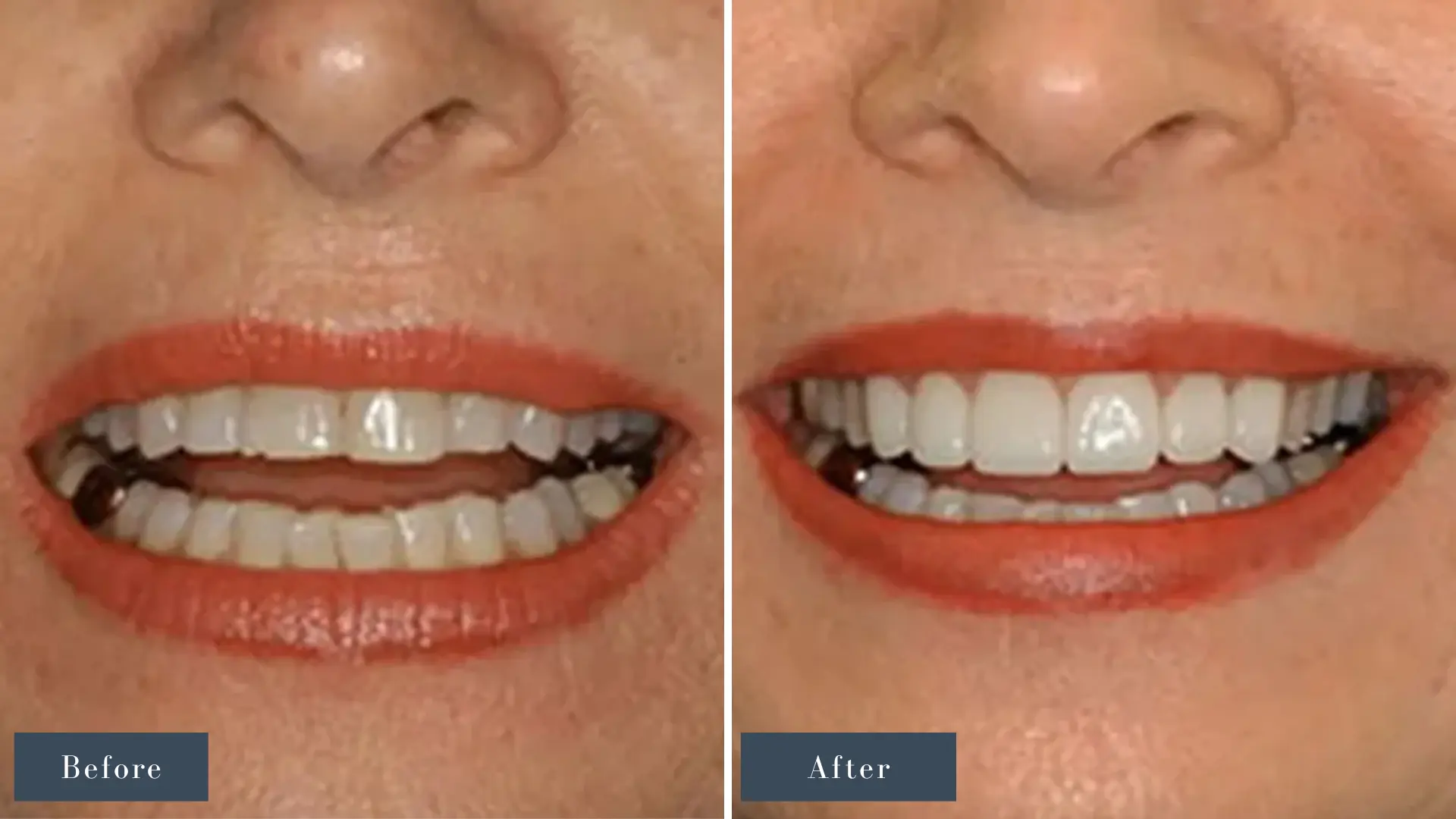 Dr Russell Kelly DDS Newport Dental Arts Cosmetic Dentistry in Newport Beach CA before and after