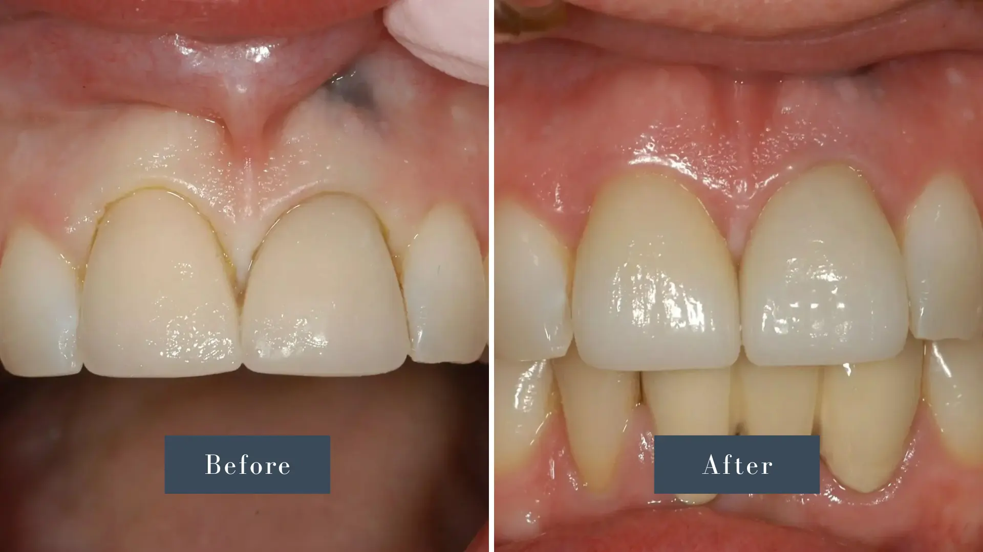 Dr Russell Kelly DDS Newport Dental Arts Crowns before and after