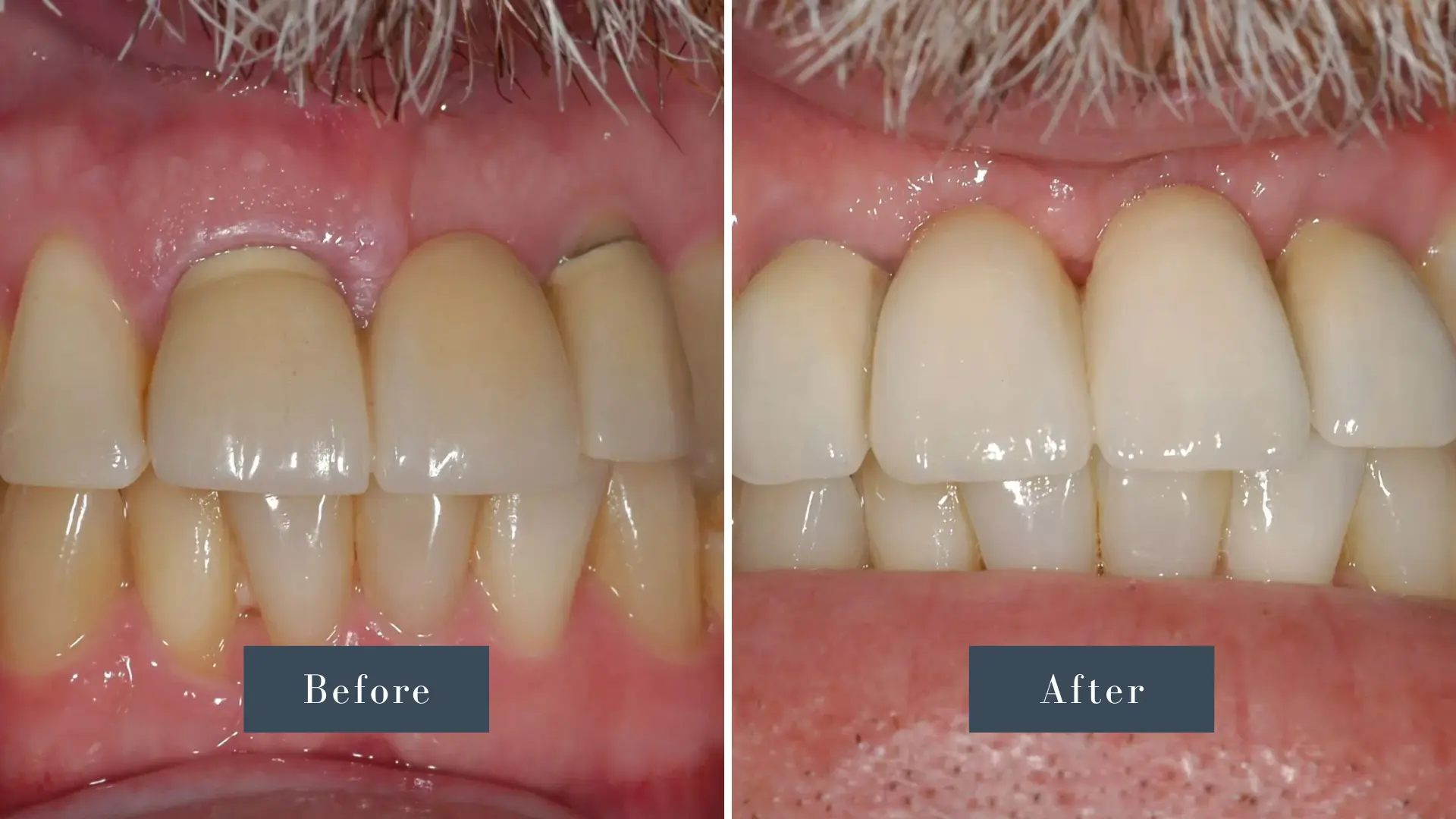 Dr Russell Kelly DDS Newport Dental Arts Dental Implants before and after