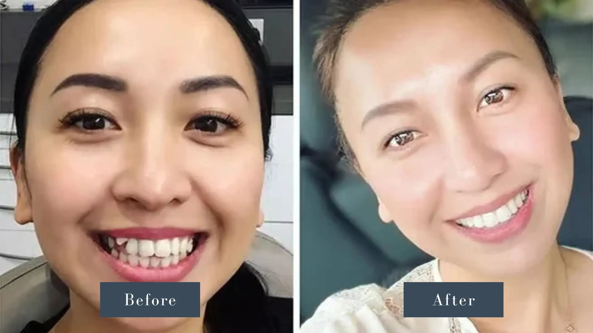 Dr Russell Kelly DDS Newport Dental Arts Dental Invisalign before and after