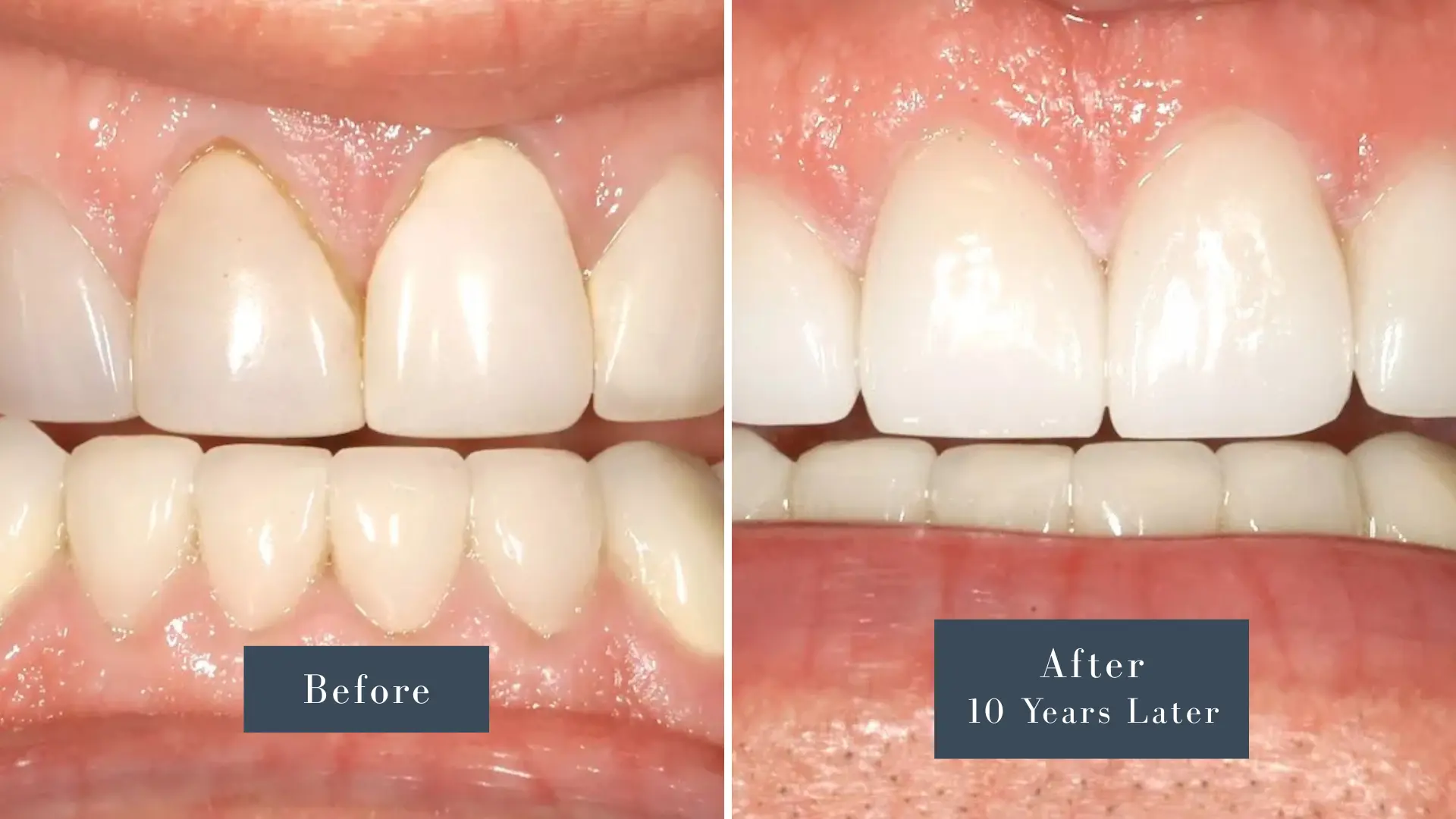 Dr Russell Kelly DDS Newport Dental Arts Porcelain Veneers before and after