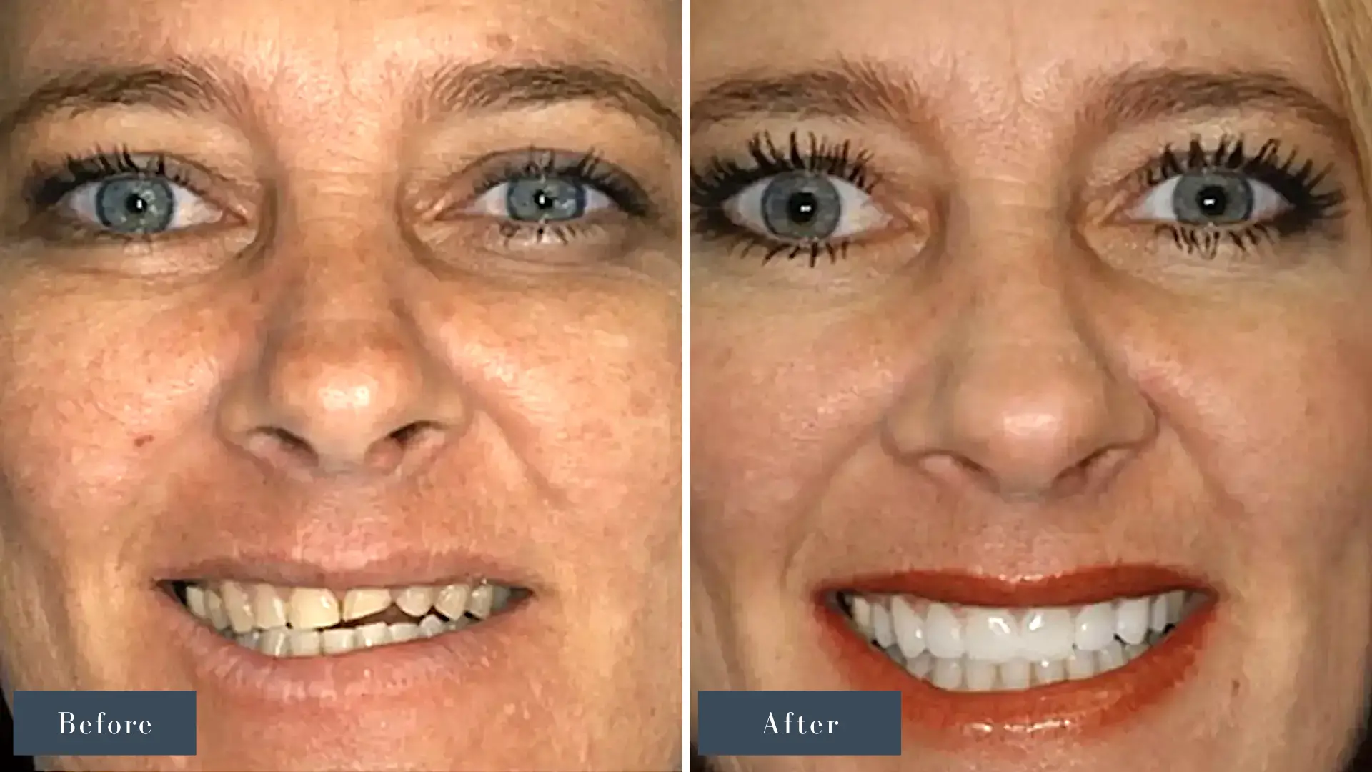 Dr Russell Kelly DDS Newport Dental Arts Smile Makeover before and after in Newport Beach